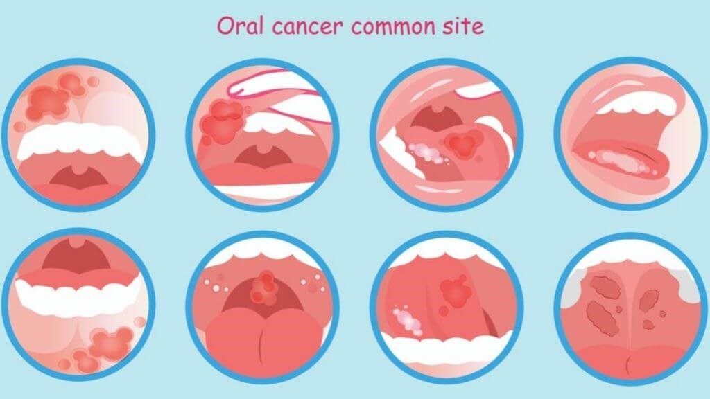 how-to-get-rid-of-canker-sores-on-tongue-canker-sores-in-mouth